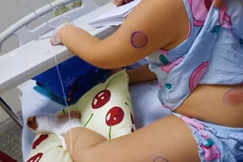 Phát hiện 1 bé gái ở Quảng Bình nhiễm vi khuẩn "ăn thịt người"