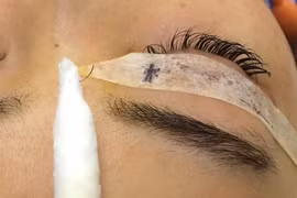 Bác sĩ mò tìm chiếc kim trong mắt cô gái trẻ Hà Nội