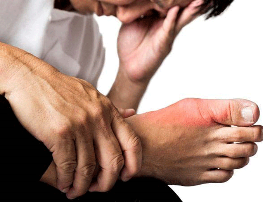 Bệnh gout: Chớ xem thường!