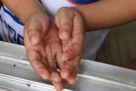 Bình Định: Một bệnh nhi tử vong nghi do bệnh tay chân miệng