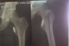 Vận động viên Pencak silat bị trúng đạn khi đang đi xe máy