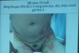 Bật lửa phát nổ trong túi quần, người đàn ông bỏng nặng