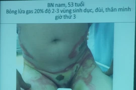 Bật lửa phát nổ trong túi quần, người đàn ông bỏng nặng