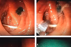 Cụ bà 71 tuổi suýt thủng ruột vì nuốt phải tăm tre