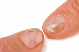 3 thay đổi ở móng tay 'tố cáo' sức khỏe của bạn có vấn đề