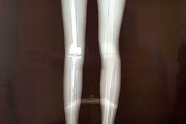 Lần đầu tiên một bệnh nhân đi lại được bằng xương đùi kim loại