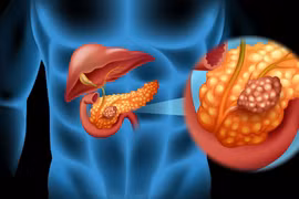 Đây là 2 loại ung thư nguy hiểm nhất