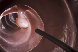 Người nào cần tầm soát ung thư đại trực tràng