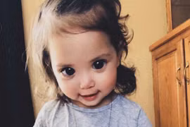 Căn bệnh ẩn sau đôi mắt to tròn của bé hai tuổi