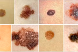 Nốt ruồi có những biểu hiện này cần nghĩ ngay tới ung thư