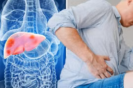 8 dấu hiệu đầu tiên của xơ gan bạn không nên bỏ qua