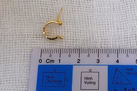 Nội soi gắp chiếc bông tai ra khỏi dạ dày bé gái