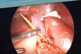 Cây tăm nhỏ - gây họa lớn