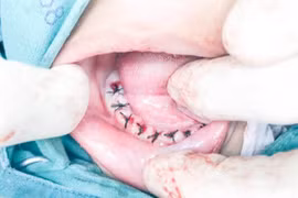 Cậu bé 4tuổi phải nhổ 18 chiếc răng vì cha mẹ quên làm điều này