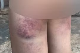 Đắk Lắk: Cô giáo đánh học sinh tím người vì không làm được bài