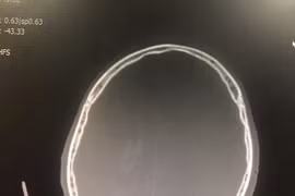 Thiếu niên 16 tuổi bị đạn bắn xuyên não khi đi săn cùng bạn