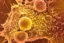 Xét nghiệm máu sử dụng trí tuệ nhân tạo phát hiện hơn 50 loại ung thư