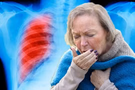 Ho như thế nào là dấu hiệu của ung thư phổi?