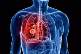 Vitamin B có thể làm tăng nguy cơ ung thư phổi ở nam giới