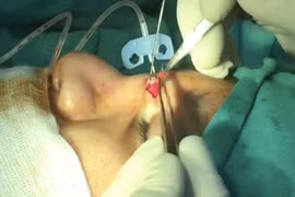 Cô gái bị chảy dịch mũi suốt 2 năm vì mảnh gạc "bỏ quên"