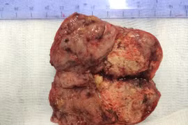 Phẫu thuật thành công bệnh nhân bị ung thư gan tái phát