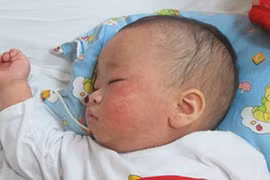 Dinh dưỡng tốt nhất cho trẻ bị sởi