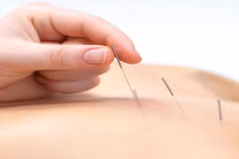 Có nên sơ cứu đột quỵ bằng châm cứu, bấm huyệt?