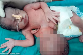 Bé gái có chiếc đầu thứ hai nằm ở… dạ dày