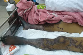 3 người cấp cứu do ăn tiết canh Tết, 1 tử vong