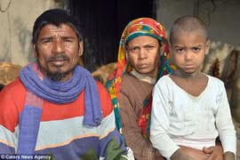 Cậu bé "hóa đá" vì căn bệnh hiếm gặp