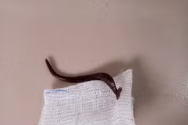 Gắp thành công con vắt rừng nằm nhiều ngày trong mũi một cháu bé