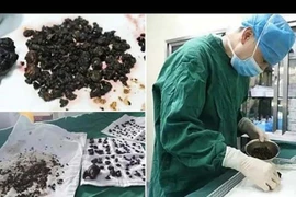 Người phụ nữ 'có' 200 viên sỏi mật do bỏ ăn sáng suốt 8 năm?