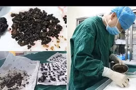 Người phụ nữ 'có' 200 viên sỏi mật do bỏ ăn sáng suốt 8 năm?