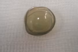 Thường xuyên bị ngứa mắt, cụ bà 67 tuổi đi khám bác sĩ và tá hỏa khi phát hiện ra thứ này