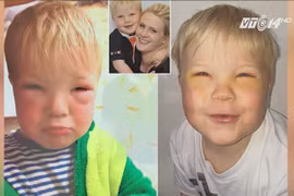 Bé trai 2 tuổi bị mù tạm thời vì mẹ nhuộm tóc