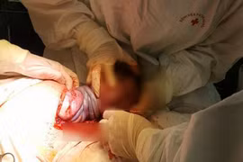 Hy hữu: Bé trai chào đời khỏe mạnh với 4 vòng dây rốn quấn cổ tại Hà Nội