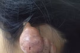 Kinh hoàng biến chứng từ bấm lỗ tai