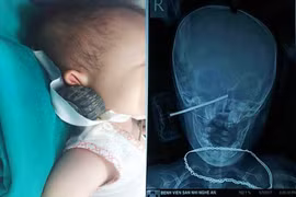 Cháu bé 11 tháng tuổi thoát chết kỳ diệu khi bị bánh xe đồ chơi găm vào đầu