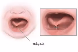 Phát hiện sớm tật dính thắng lưỡi ở trẻ
