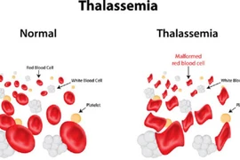 Em bé đầu tiên được lọc gene bệnh tan máu khi thụ tinh trong ống nghiệm là người Gia Lai