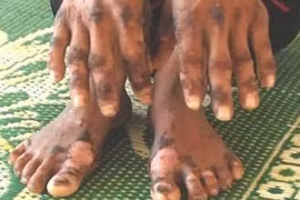 "Bệnh lạ" ở Quảng Ngãi không lạ như đồn đại