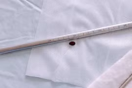 Cứu sống bé gái hơn 2 tuổi bị hóc hạt dưa