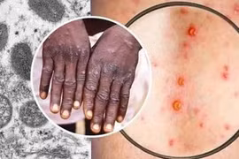 Bang New York (Mỹ) ban bố tình trạng khẩn cấp về dịch bệnh