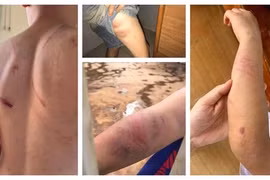 Đak Lak: Bố ruột và bà nội bị tố đánh đập cháu bé 9 tuổi dã man