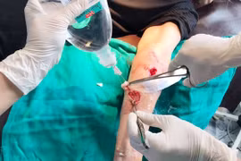 Cụ bà bị 30 vết thương do chó berger cắn phải nhập viện