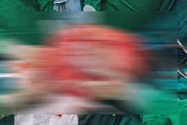 Hy hữu cụ bà 78 tuổi mang khối u buồng trứng 30 kg