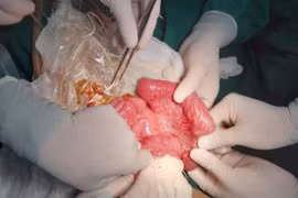 Bé 3 tuổi nôn ra giun,BS tròn mắt gắp thêm gần 0,5kggiun trong bụng