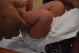 Bố mẹ tự tay cắt bao quy đầu tại nhà,con trai 5 tháng tử vong