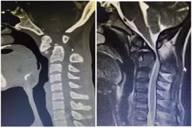 Bị liệt tứ chi do đắp thuốc lá chữa đau cột sống cổ