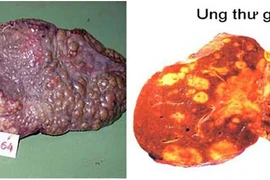 Nguyên nhân khiến người Việt mắc và chết vì ung thư gan cao thứ 4TG